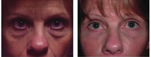 Eye Bag correction at Perfect FACE